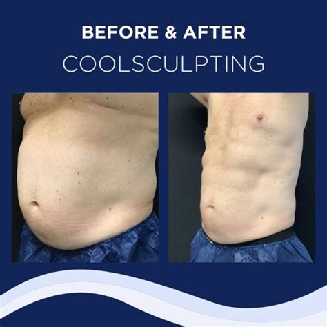 dangers of coolsculpting.